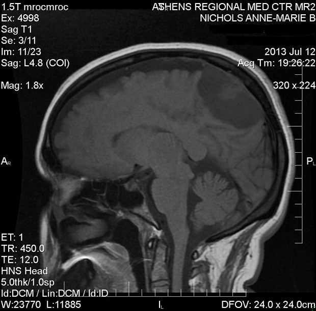 MRI of a menigioma.